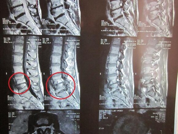 Cervical Osteochondrosis Diagnose