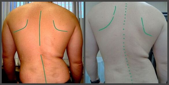 Krümmung der Säule mit Osteochondrose