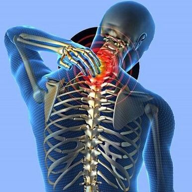 Nackenschmerzen mit zervikaler Osteochondrose
