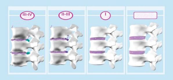 Stadien der zervikalen Osteochondrose