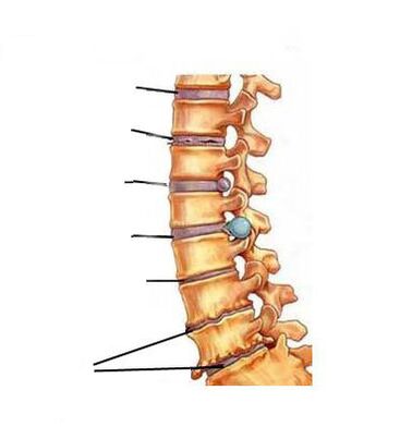 Wie sich Osteochondrose entwickelt