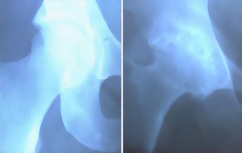 Osteoarthritschum des Kniegelenks