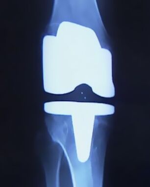 X -Ray des Knies mit einer künstlichen Prothese nach der Operation, um das Gelenk zu ändern