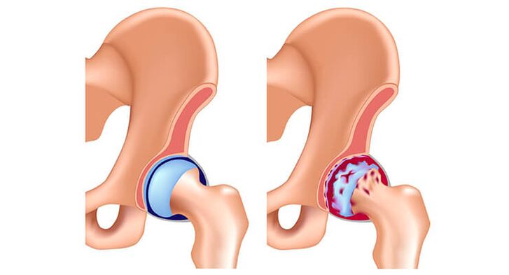 gesundes Hüftgelenk, das von Arthrose betroffen ist