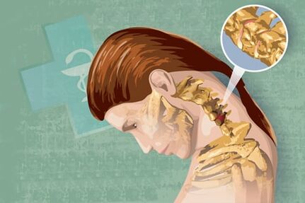 Reflexsymptome von Osteochondrose
